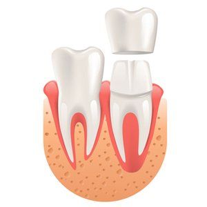 dental crown illustration