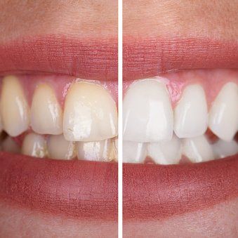 before & after teeth whitening Joondalup