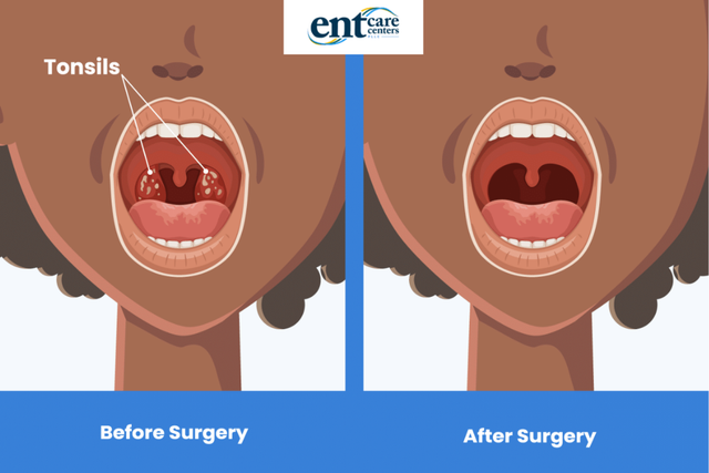 tonsillectomy procedure step by step