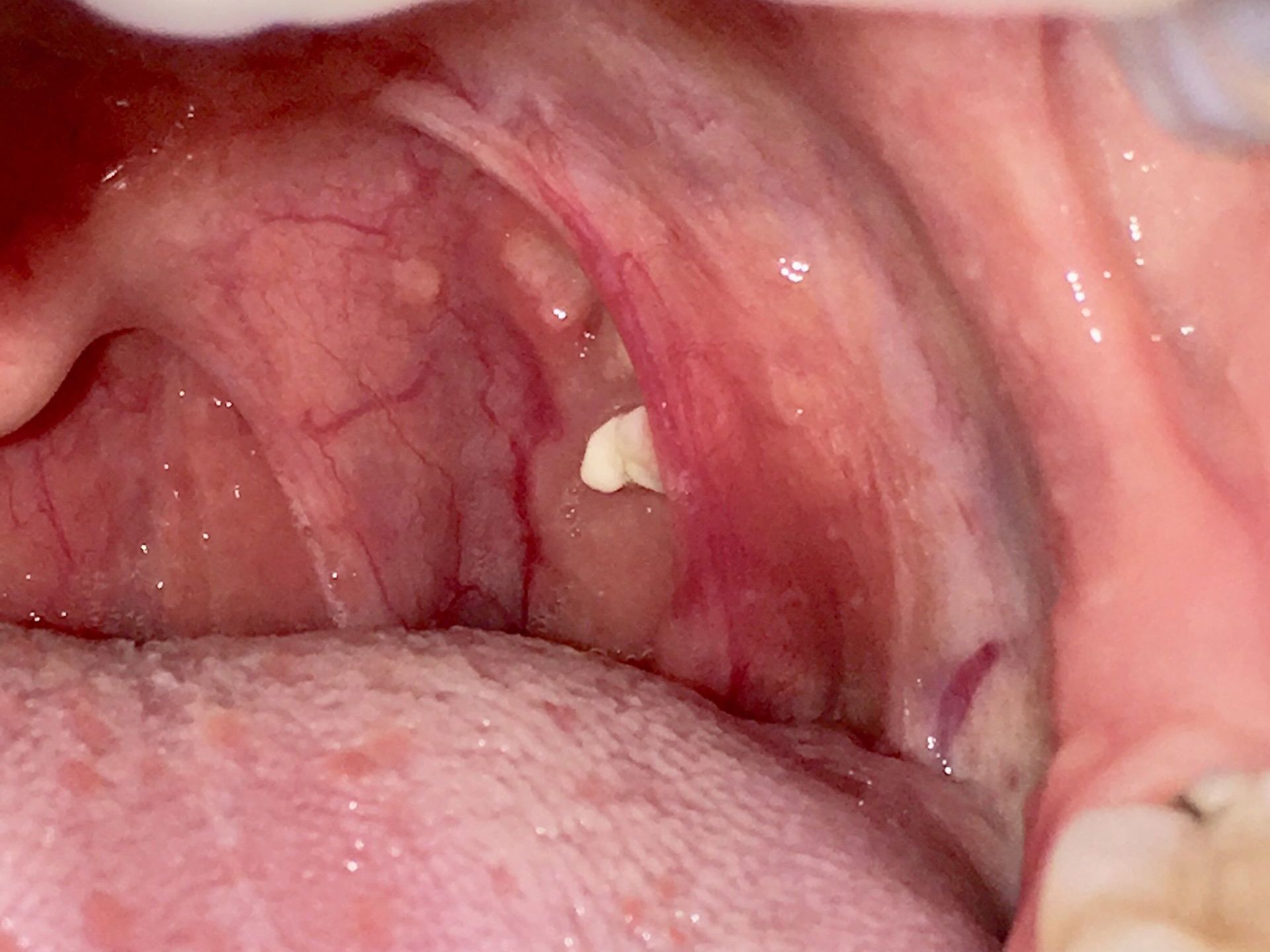 Tonsil stone in the left throat