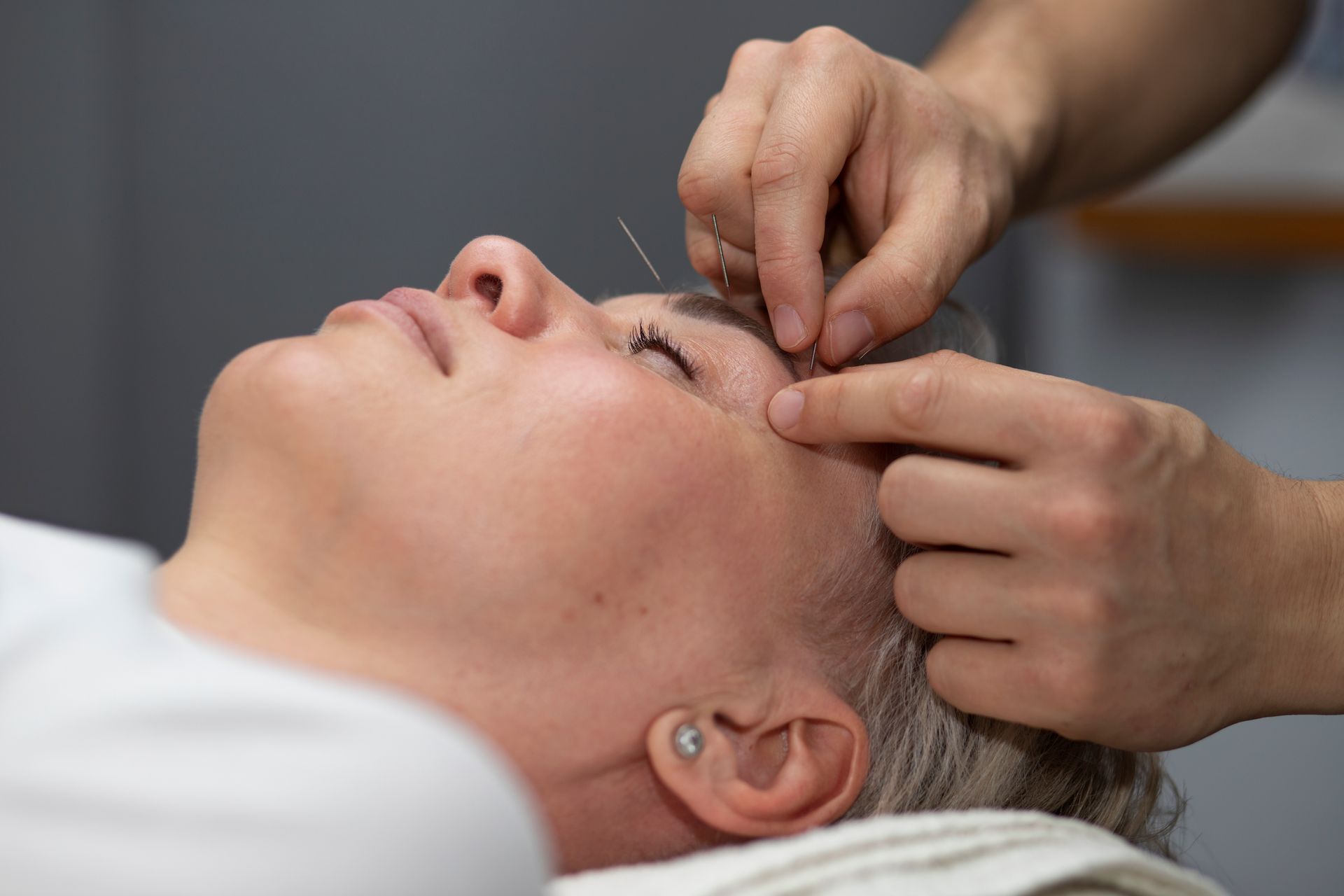 A woman is getting acupuncture on her face.