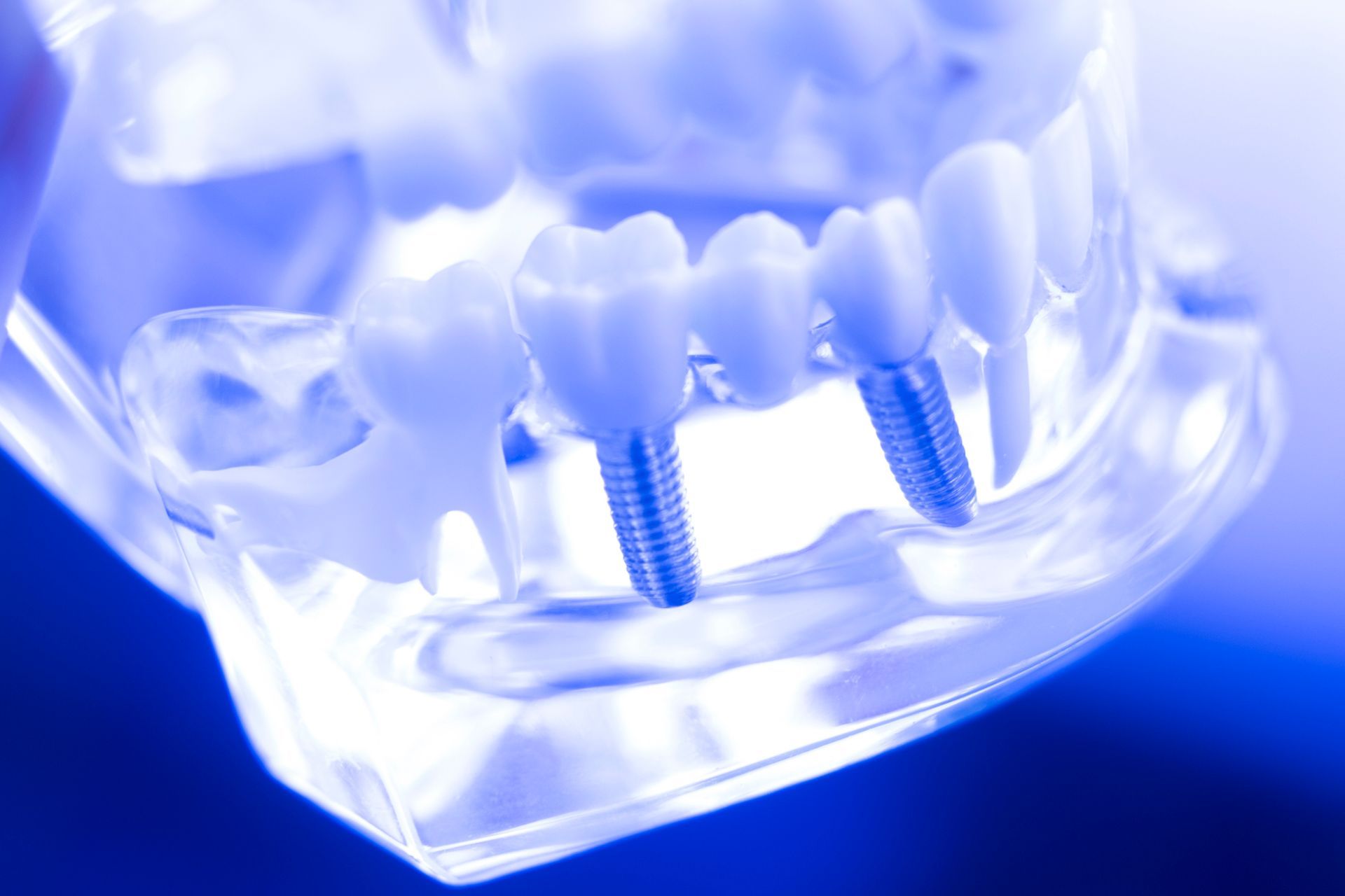 protesi fisse e mobili