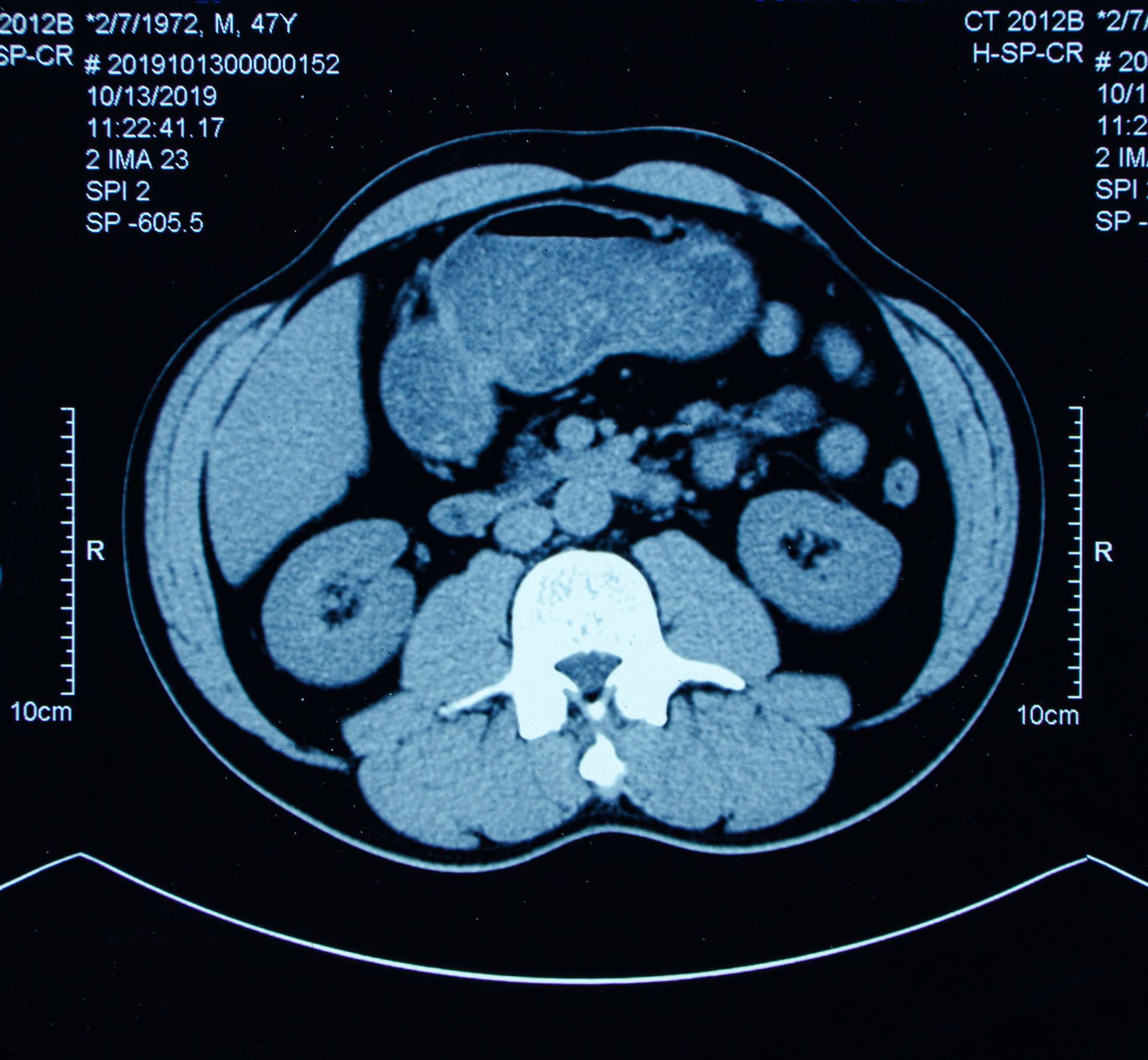 TC dell'addome che mostra gli organi interni in sezione trasversale. Sono visibili la colonna vertebrale e l'intestino.