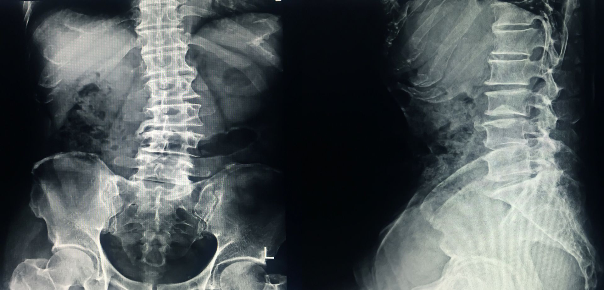 radiografia colonna vertebrale