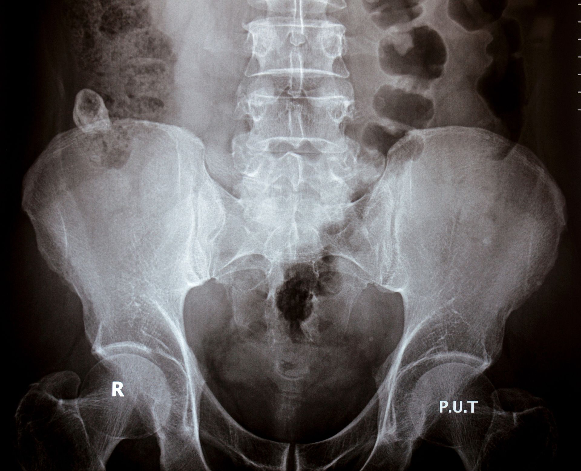 radiografia colonna vertebrale