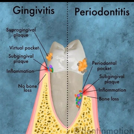 Diagram comparing gingivitis and periodontitis, showing plaque, inflammation, bone loss, and pocket formations.