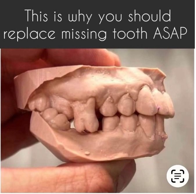 Dental mold showing teeth shifting due to a missing tooth, with text stating the importance of replacing missing teeth.