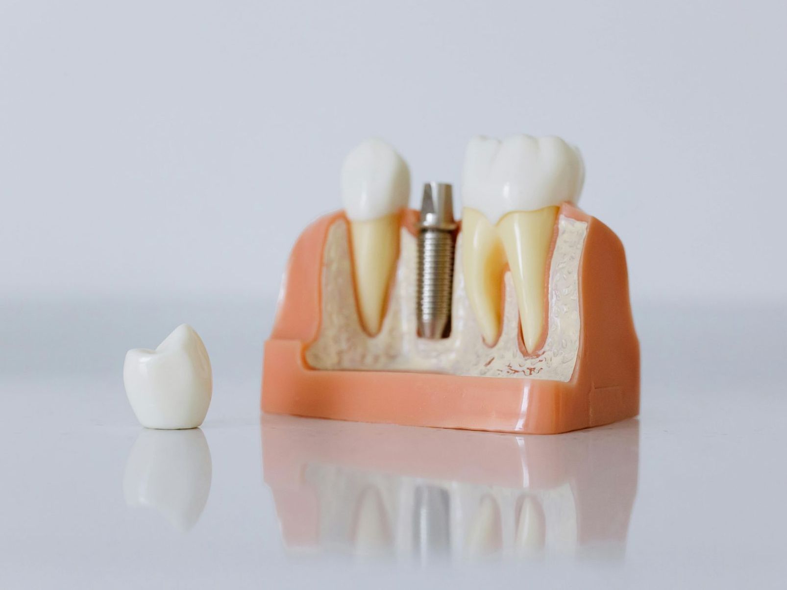 A model of a tooth with a dental implant in it