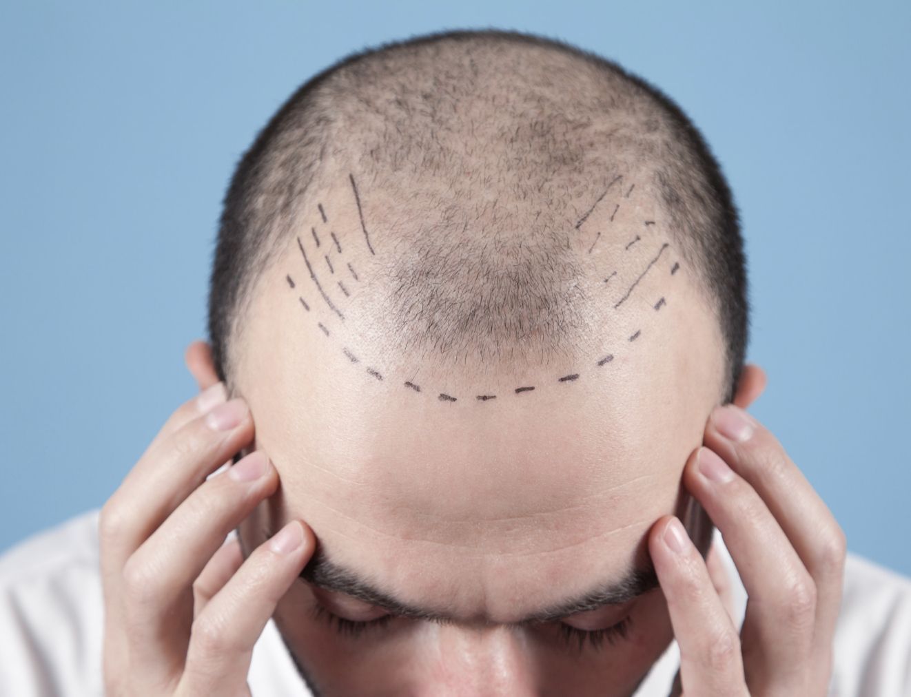 Scalp Micropigmentation for hair loss solutions
