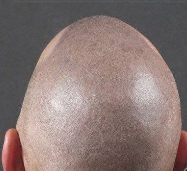 Balding male takes picture after getting hair replacement service also known as scalp micropigmentation