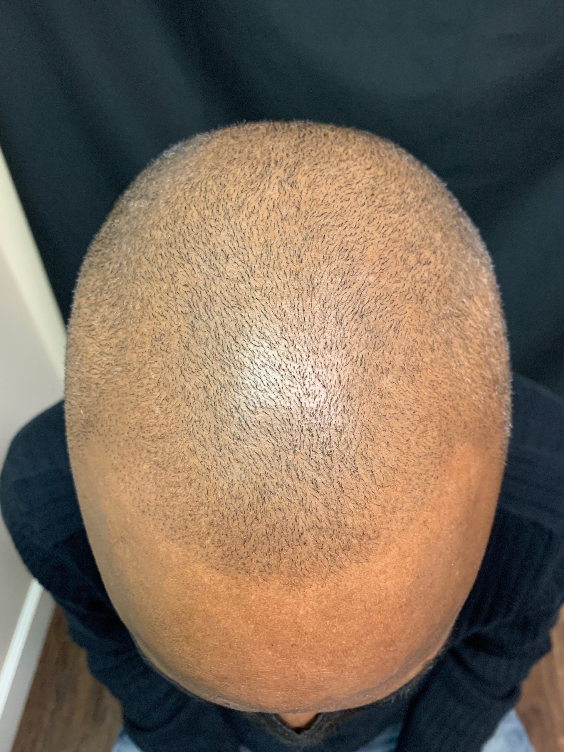 A male after getting scalp micropigmentation to help with receding hairline