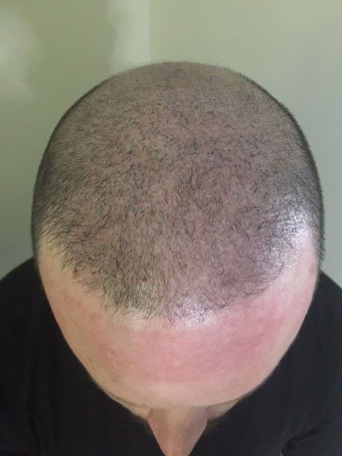 A male after  getting SMP scalp micropigmentation to help with thinning and sparse hair