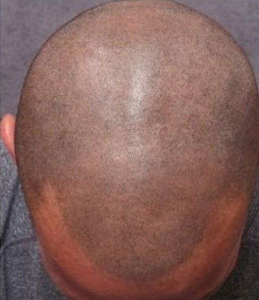 A picture taken after getting scalp micropigmentation also know as hair replacement service