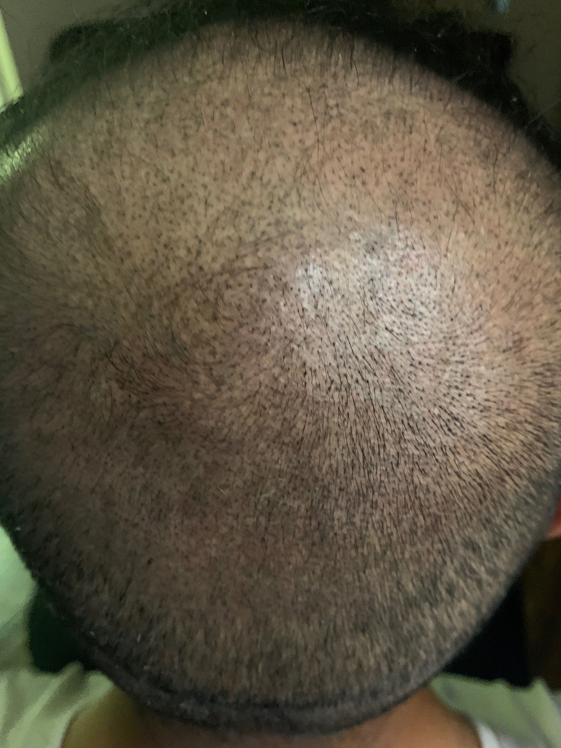 A picture taken after balding male gets hair replacement service also known as scalp micropigmentation