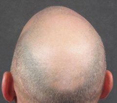 A balding male before getting hair replacement service in Chester, NJ