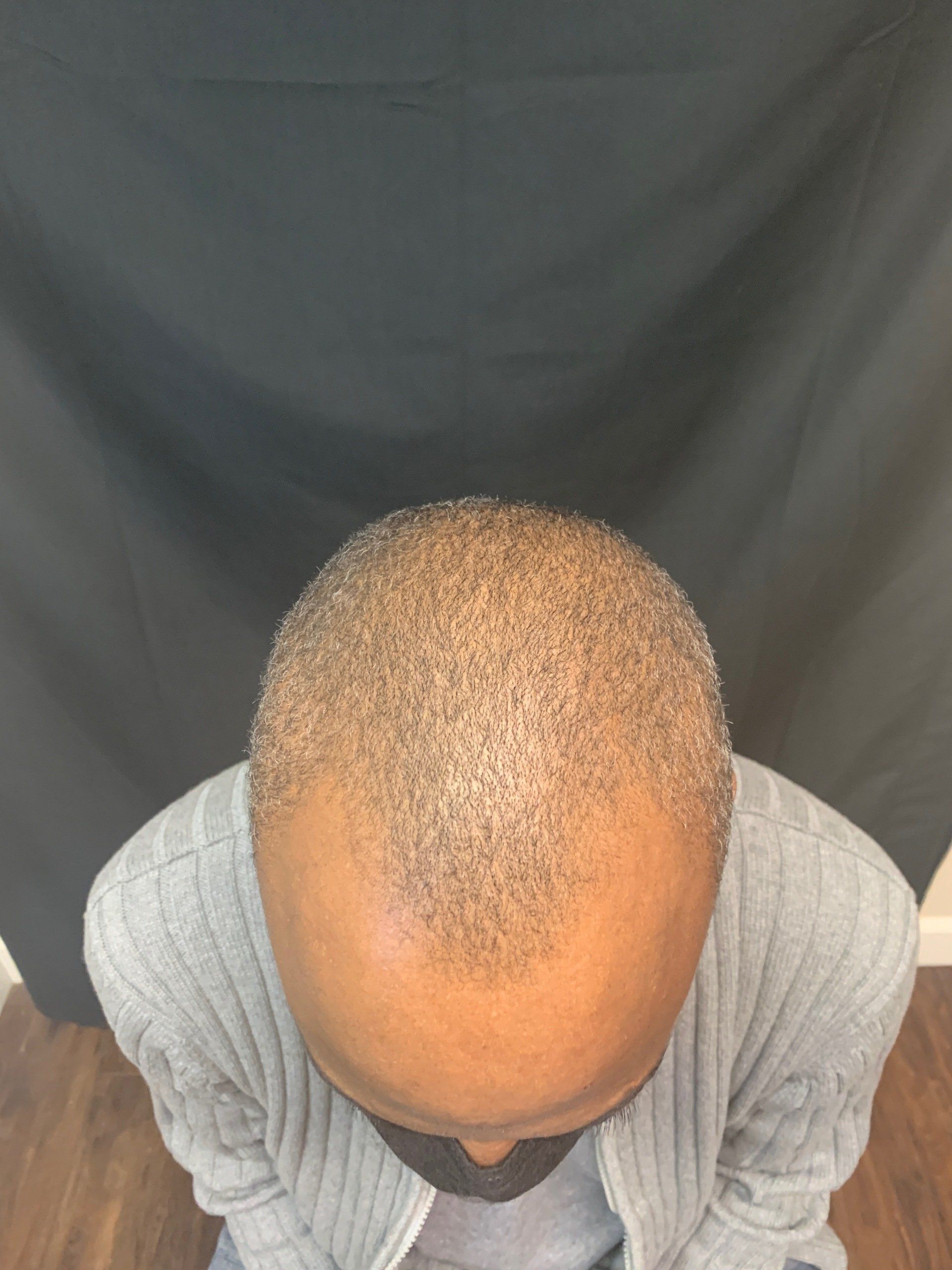 A male before getting scalp micropigmentation to help with receding hairline