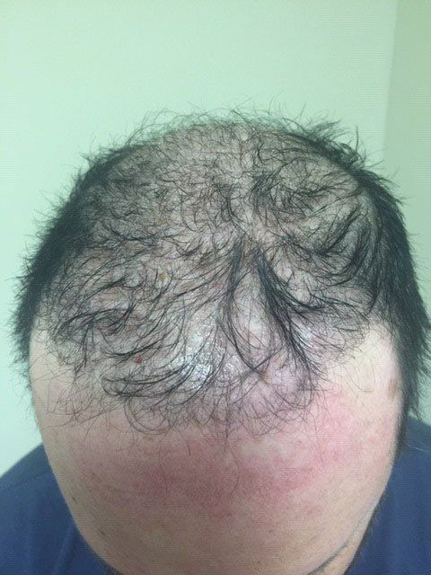 A male with thinning hair before getting SMP scalp micropigmentation