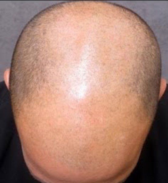 A picture taken before getting scalp micropigmentation also know as hair replacement service