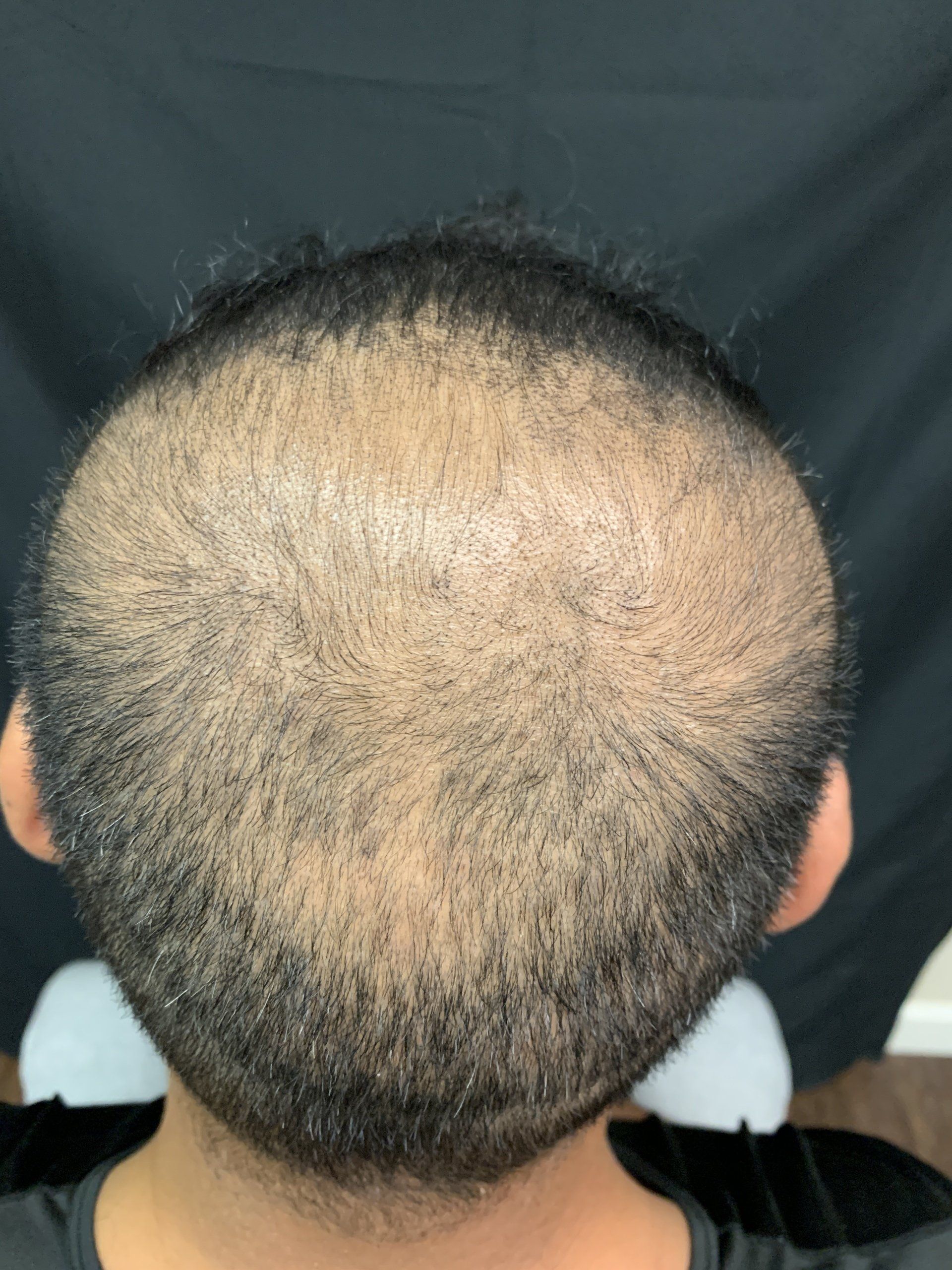 A picture taken before balding male gets hair replacement service also known as scalp micropigmentation