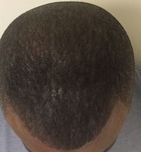 A man's thinning hair before getting scalp micropigmentation in Chester, NJ