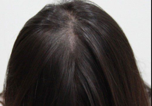 A woman after getting scalp micropigmentation hair density to help with thinning hair