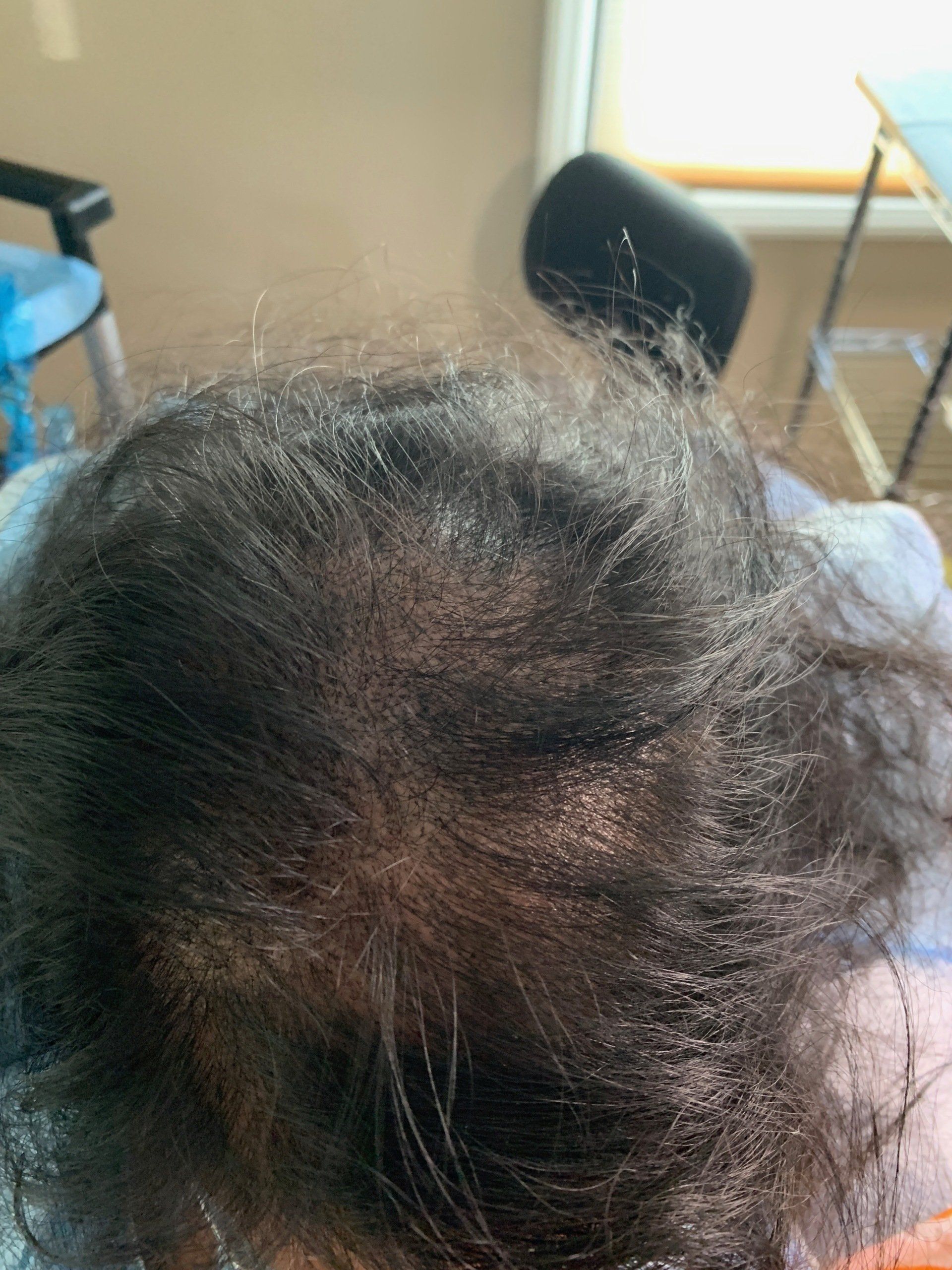 A picture taken after woman gets scalp micropigmentation hair density to create fuller hair