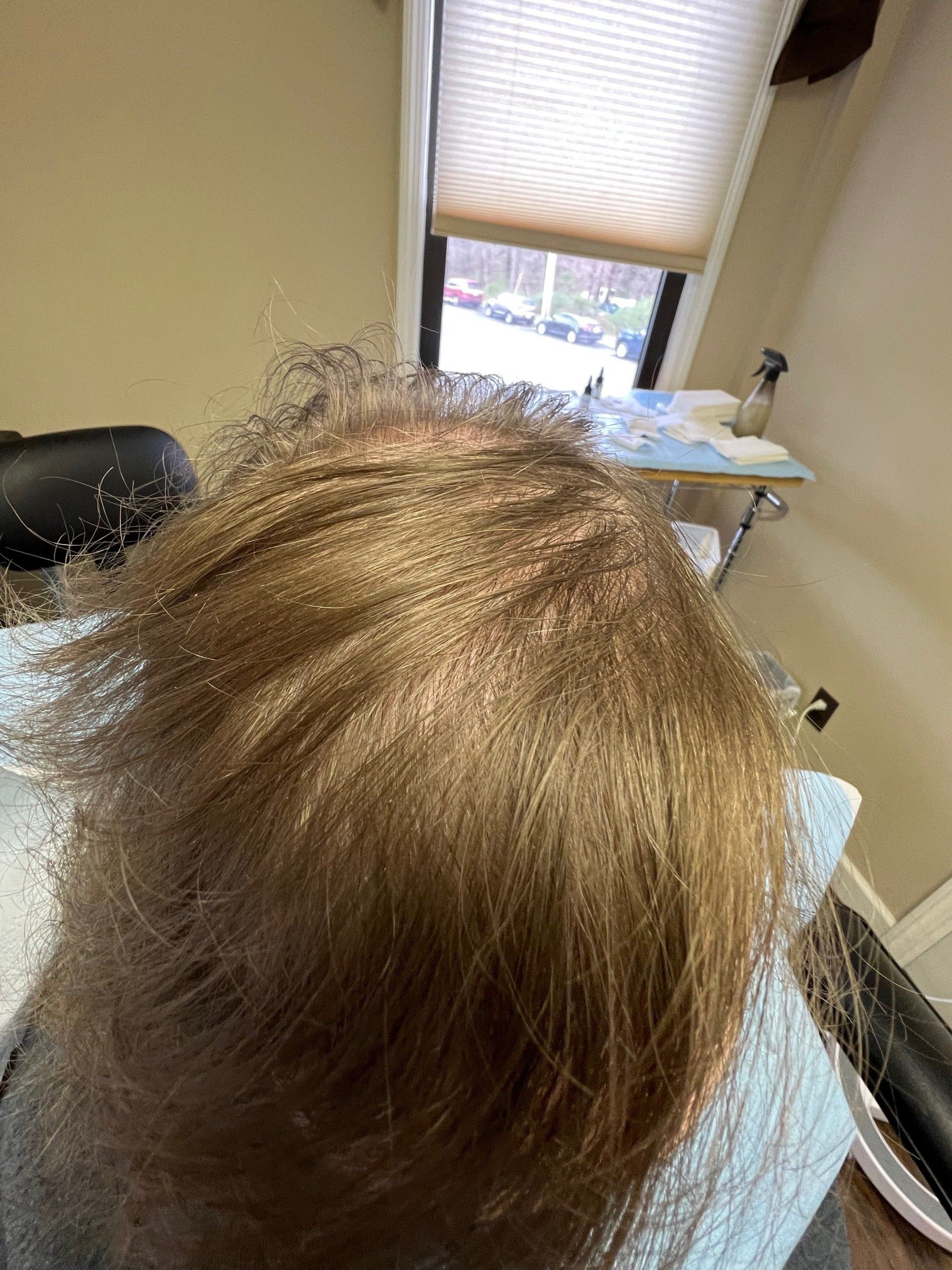 Hair replacement service after getting hair density treatment