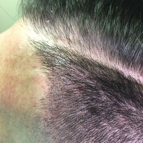 Male with thinning hair takes picture after getting hair replacement service also known as scalp micropigmentation hair density treatment