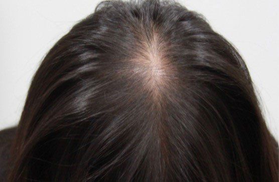 A woman before getting scalp micropigmentation hair density to help with thinning hair