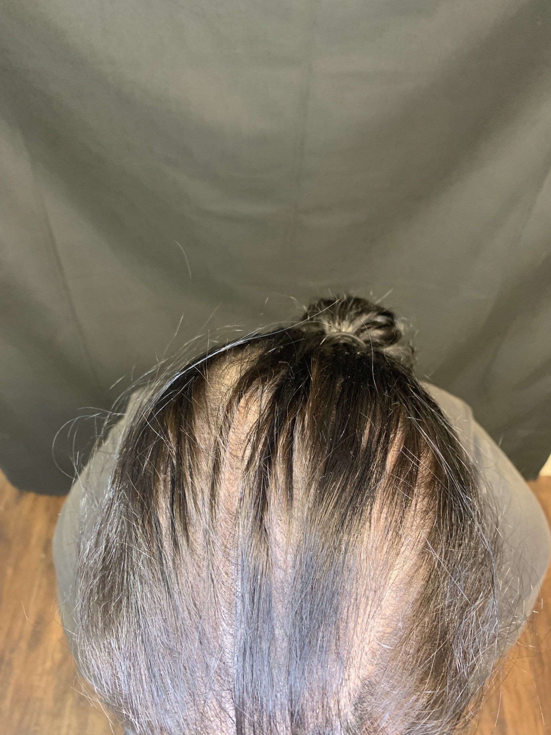 A picture taken before woman gets scalp micropigmentation hair density treatment to create fuller hair