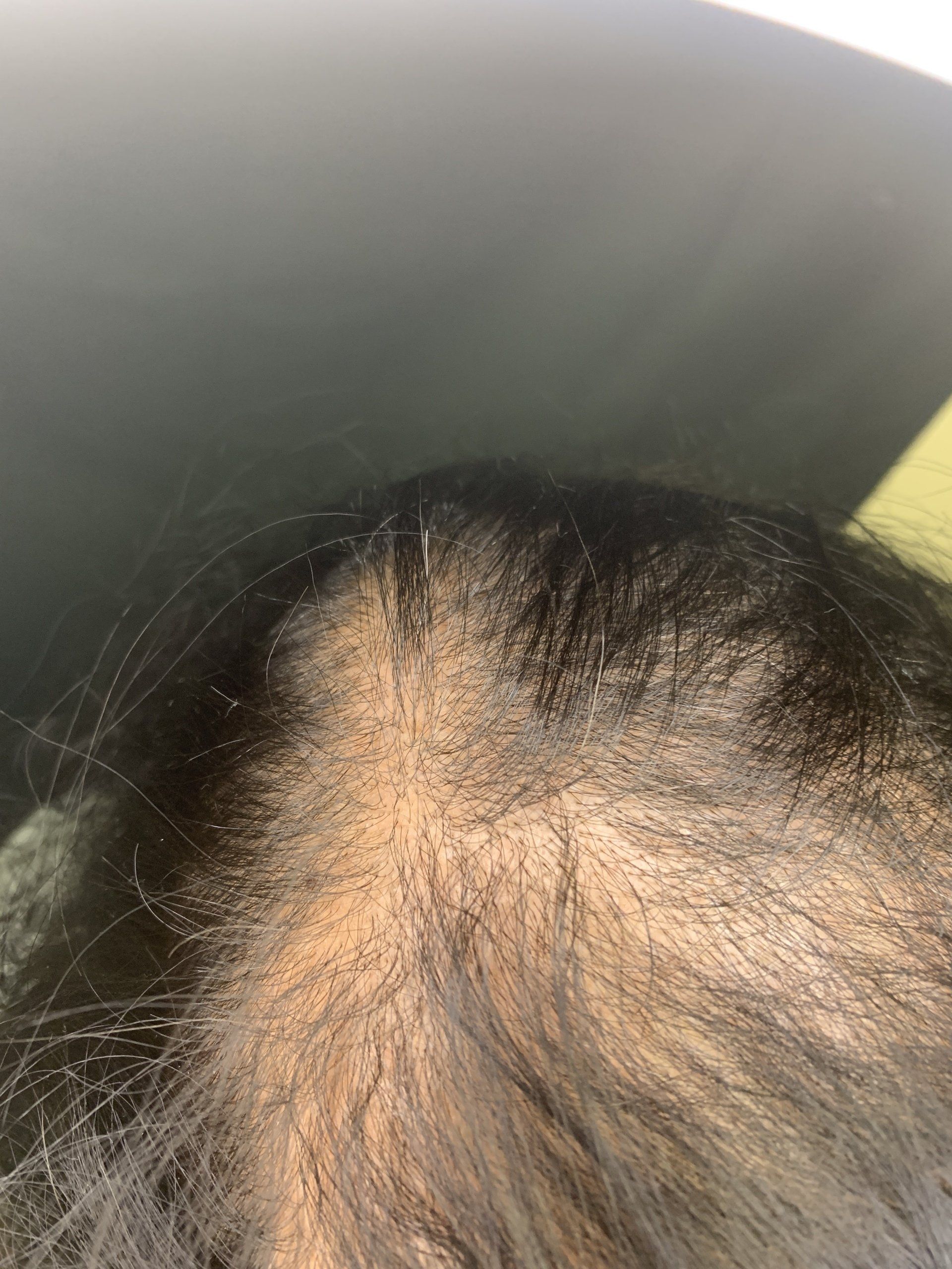A picture taken before woman gets scalp micropigmentation hair density to create fuller hair