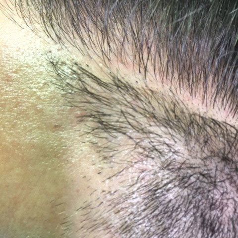 Male with thinning hair takes picture before getting hair replacement service also known as scalp micropigmentation hair density treatment