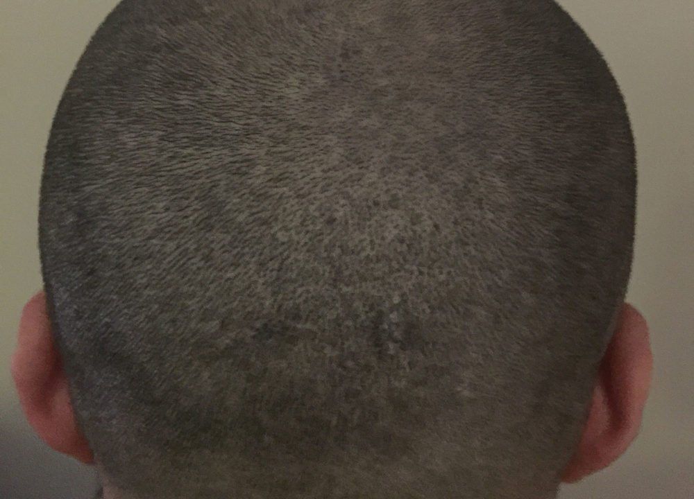 A picture taken after male gets scalp micropigmentation scar camouflage to hide scar