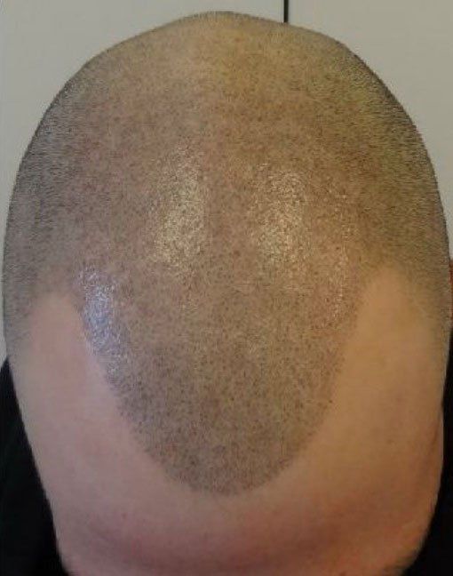 A male after getting scalp micropigmentation scar camouflage to hide scar