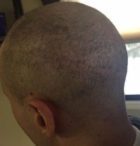 Male with scar takes picture after getting hair replacement service also known as scalp micropigmentation scar camouflage