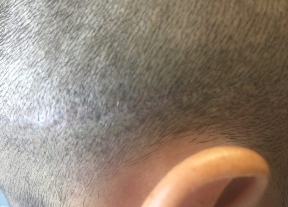 A picture taken after getting scalp micropigmentation scar camouflage to hide scar