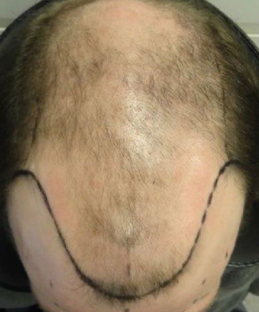 A male before getting scalp micropigmentation scar camouflage to hide scar