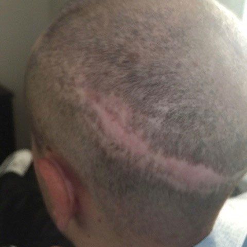 Male with scar takes picture before getting hair replacement service also known as scalp micropigmentation scar camouflage