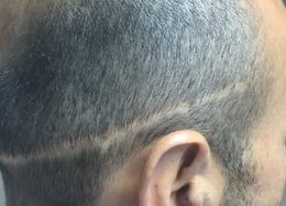 A male with a scar before getting the scar hidden with scalp micropigmentation in Chester, NJ