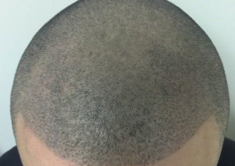 A man after receiving scalp micropigmentation because of thinning hair