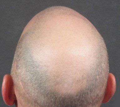 Male balding before getting scalp micropigmentation