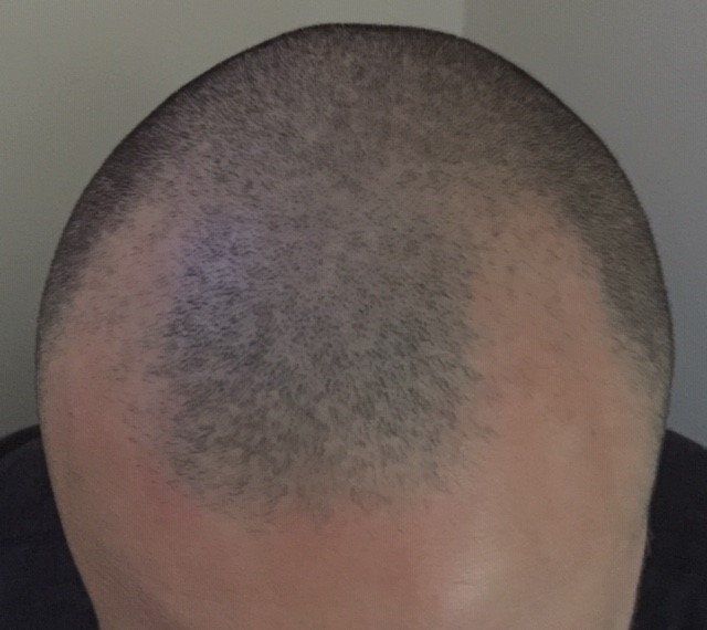 A man with receding hairline before getting scalp micropigmentation