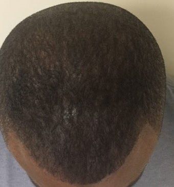 Man after getting scalp micropigmentation hair density treatment to make hairline look fuller