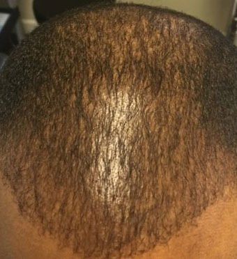 Man with thinning hair before getting SMP scalp micropigmentation hair density treatment