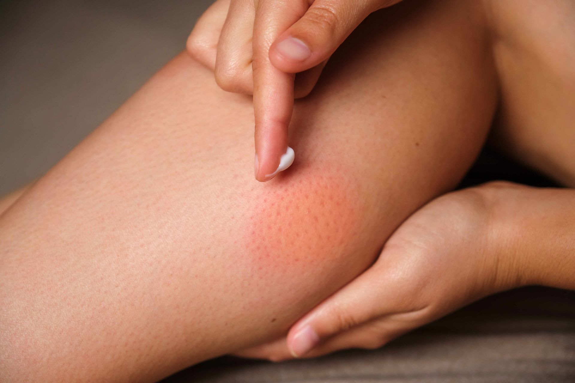 Woman treating bug bite by applying medicine cream. 