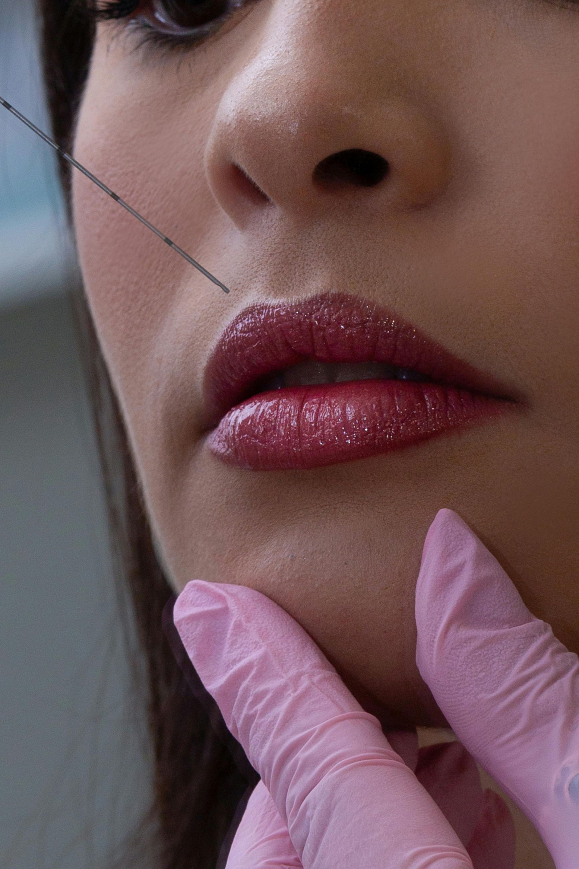 A woman is getting a botox injection in her face.