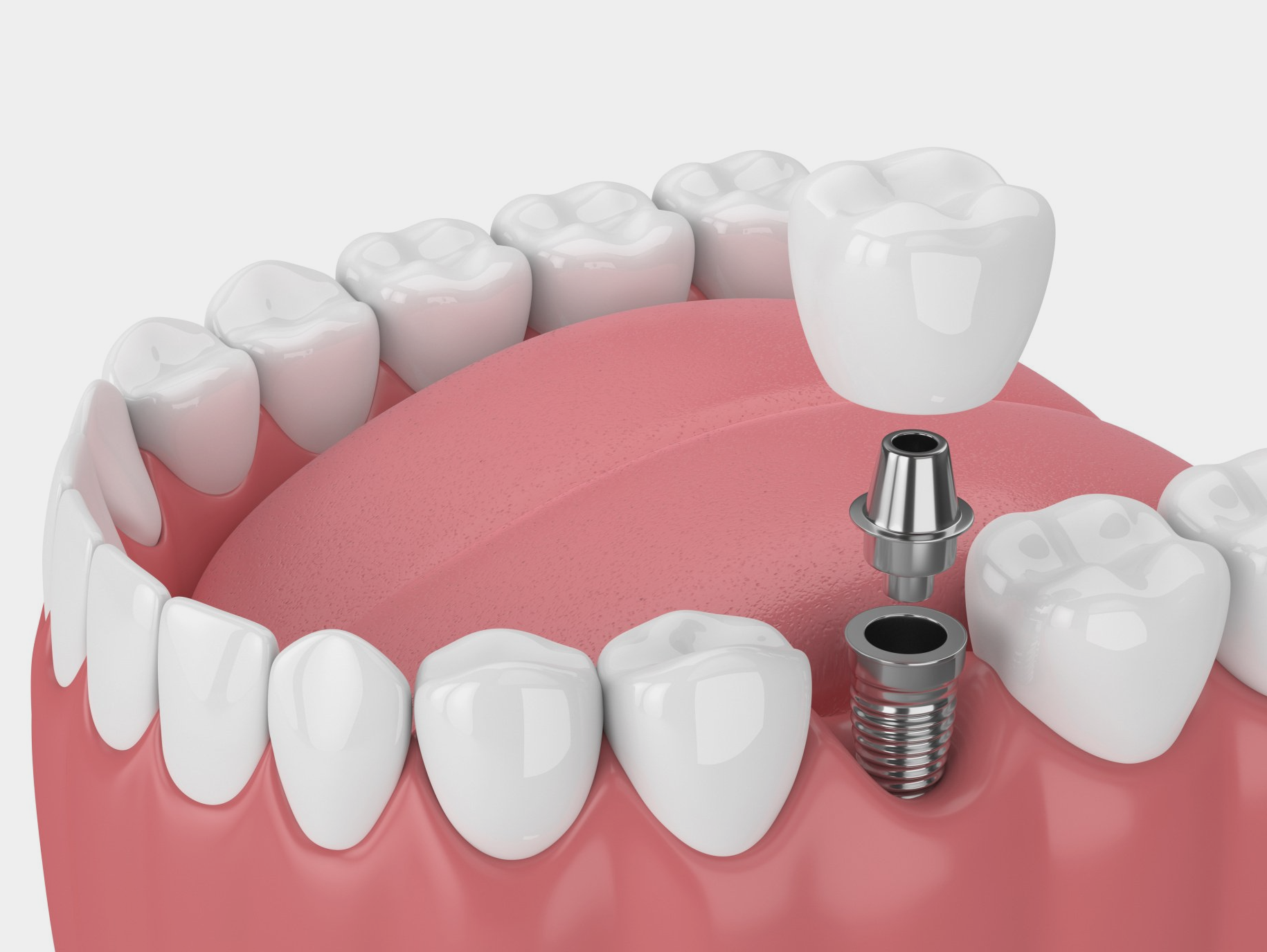 Implant With a Crown