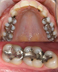 Before restorative dentistry