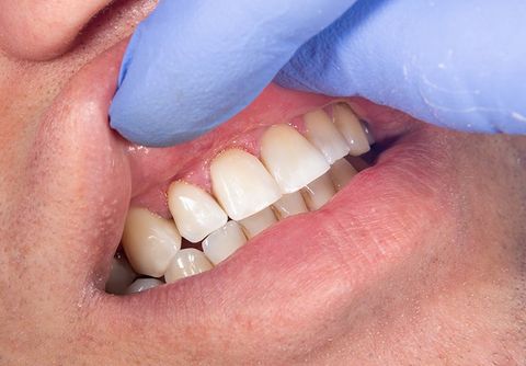 Checking the Teeth — Clarkston, MI — Mark Frenchi DDS
