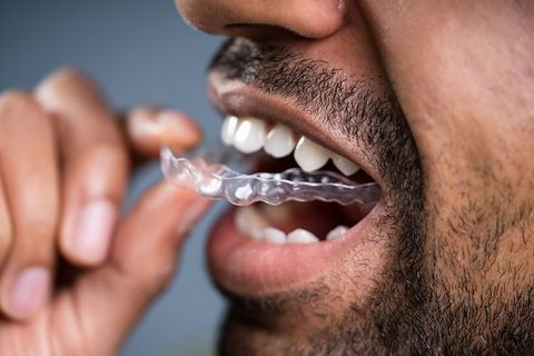 Man Putting Transparent Aligner on Teeth — Clarkston, MI — Mark Frenchi DDS